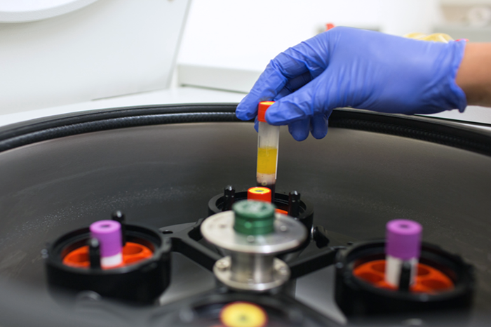 RheumLife - Reducing Inflammation A rheumatology investigator handling viables in a lab while searching for a cure for rheumatic disease