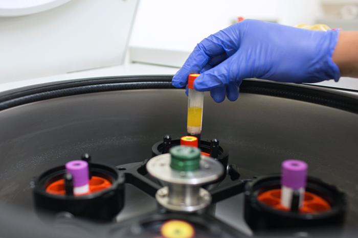 A rheumatology investigator handling viables in a lab while searching for a cure for rheumatic disease